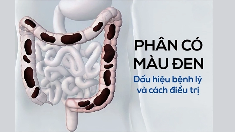 Phân màu đen có bị sao không?