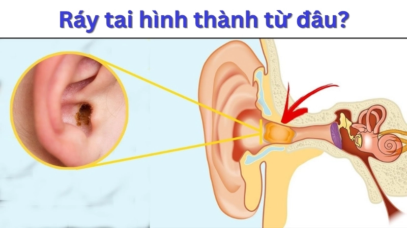 Ráy tai hình thành từ đâu? Từ dịch tiết tự nhiên của cơ thể và tế bào da chết trong ống tai