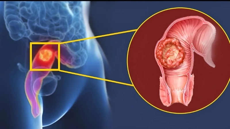 Sau khi được hình thành, phân được đẩy vào trực tràng – phần cuối của đại tràng