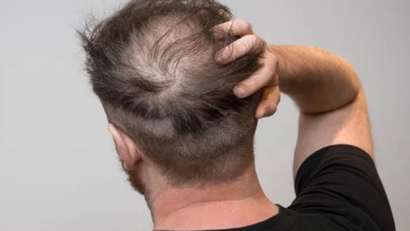Phương pháp và mẹo chữa trị khi bị rụng tóc nhiều