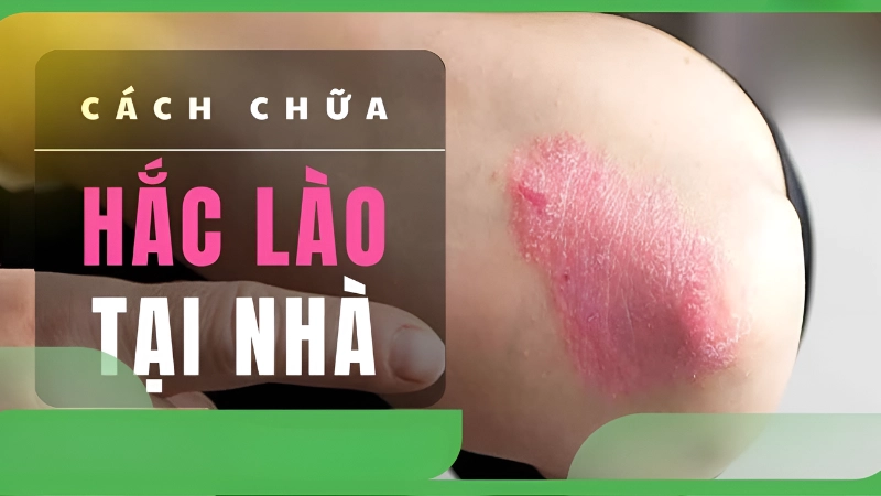 Top mẹo dân gian chữa hắc lào đơn giản, hiệu quả