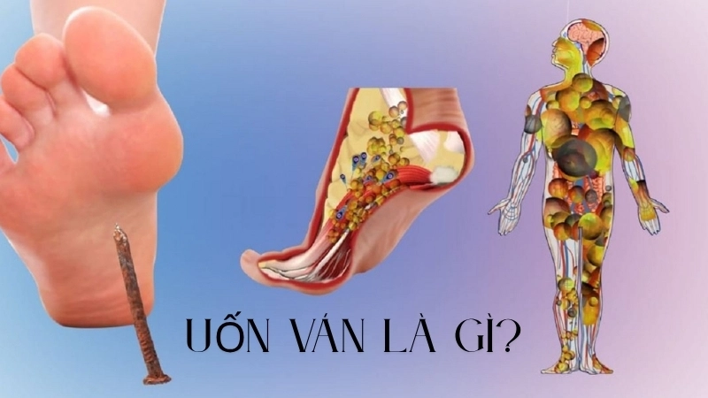  Uốn ván là gì và tác nhân gây bệnh là vi khuẩn Clostridium tetani sống trong môi trường