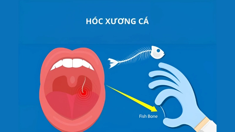 Lý do khiến bạn bị hóc xương cá 