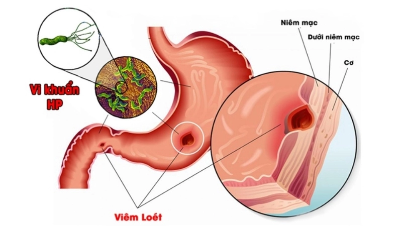 Dấu hiệu nhận biết khi bị viêm dạ dày hp
