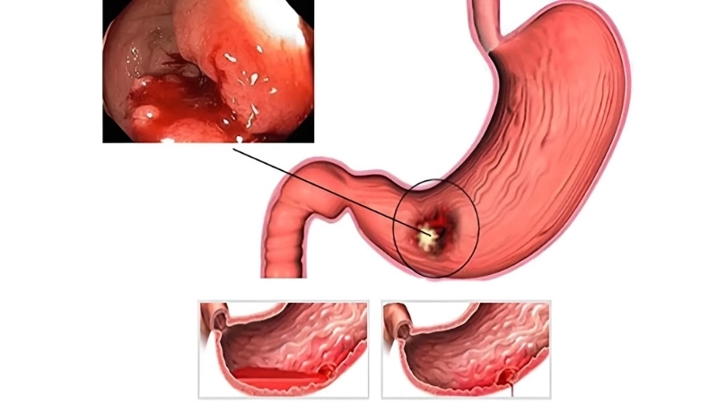 Phương pháp và mẹo chữa trị khi bị viêm dạ dày hp