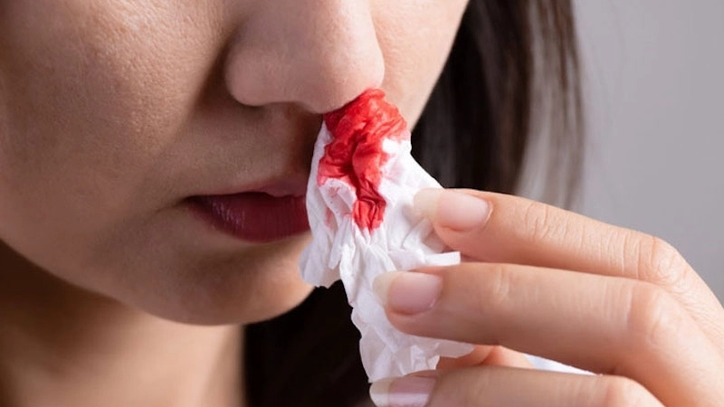 Dấu hiệu nhận biết khi bị xì mũi ra máu