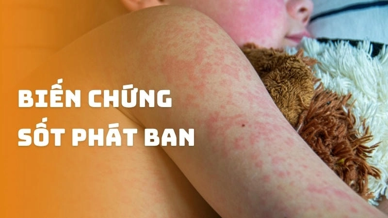 Các biến chứng sốt phát ban thường nhẹ hơn