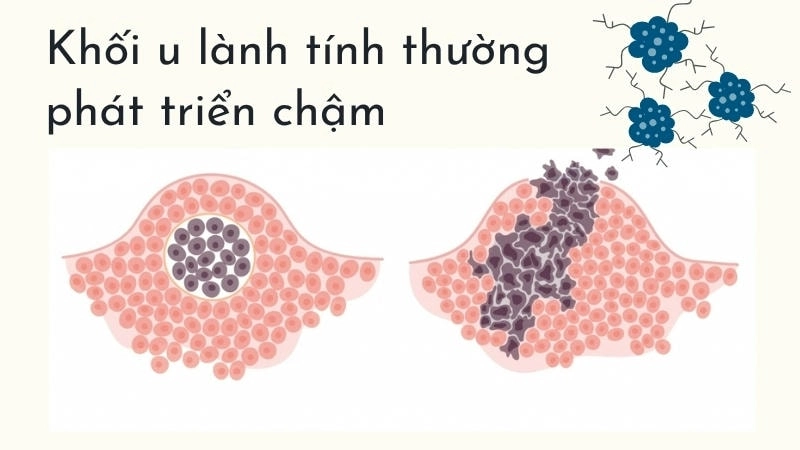 Khối u lành tính thường phát triển chậm, có giới hạn rõ ràng và không di căn