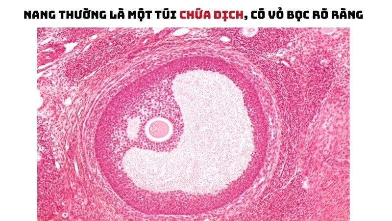Nang thường là một túi chứa dịch, có vỏ bọc rõ ràng, có thể xuất hiện ở nhiều vị trí trong cơ thể