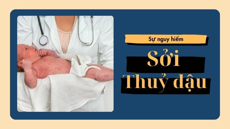 Sởi được coi là nguy hiểm hơn thủy đậu