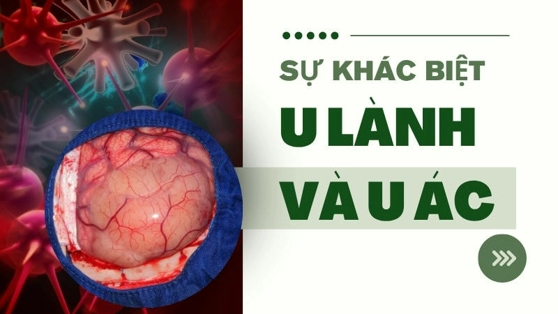 Sự khác biệt giữa u lành tính và u ác tính nằm ở tốc độ phát triển, khả năng xâm lấn