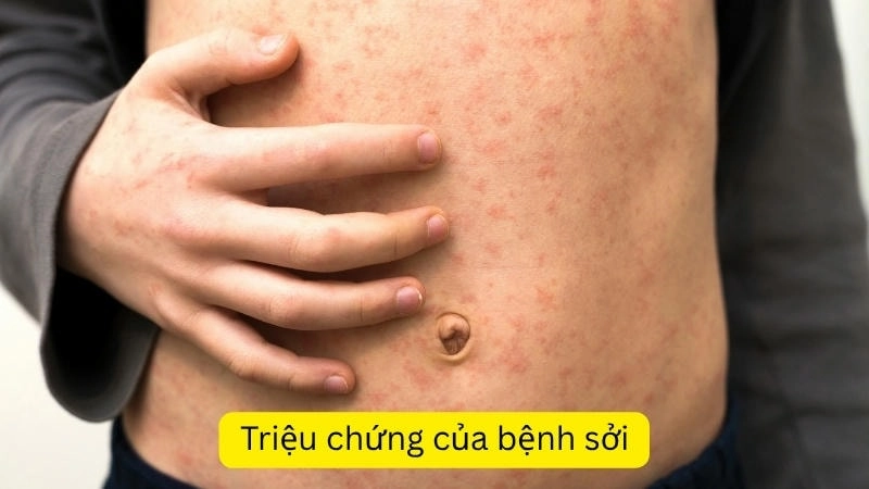 Triệu chứng của bệnh sởi và thủy đậu khác nhau