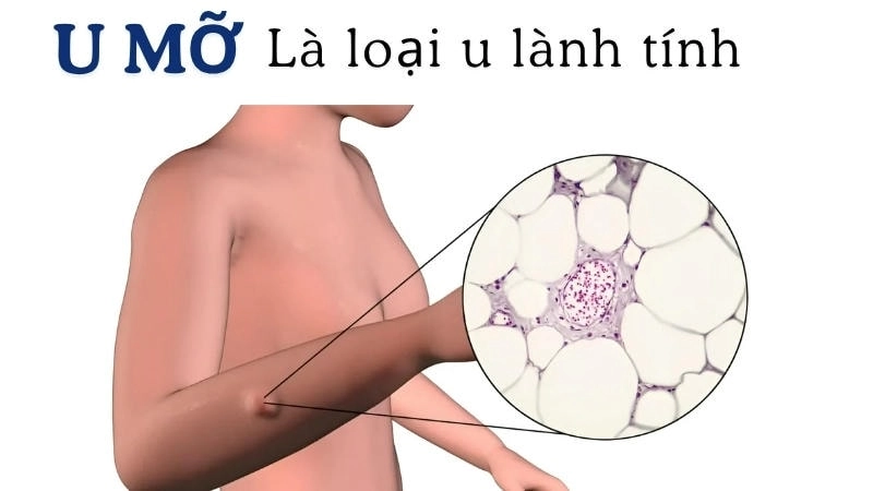 U mỡ thường mềm, không đau và dễ di động dưới da, là loại u lành tính rất phổ biến