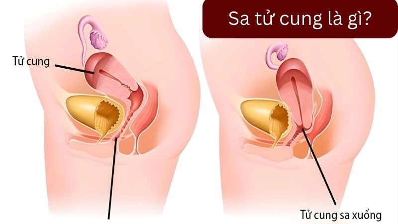 Sa tử cung là gì và tại sao chị em cần tự kiểm tra thường xuyên?