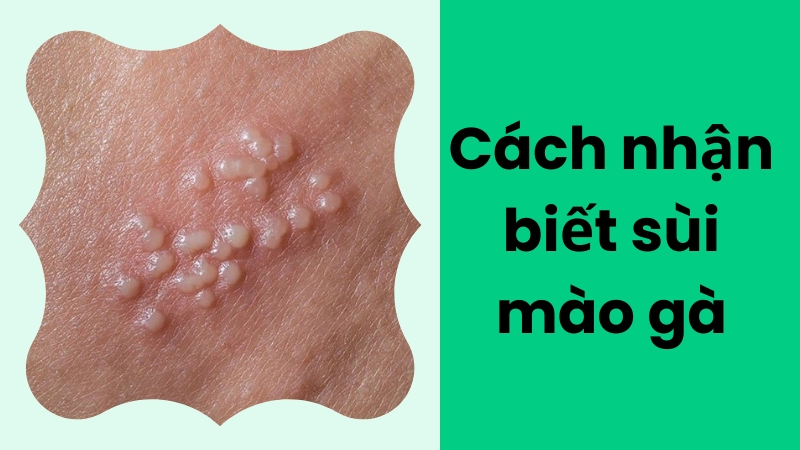 Sùi mào gà xuất hiện ở đâu và trông như thế nào ban đầu?