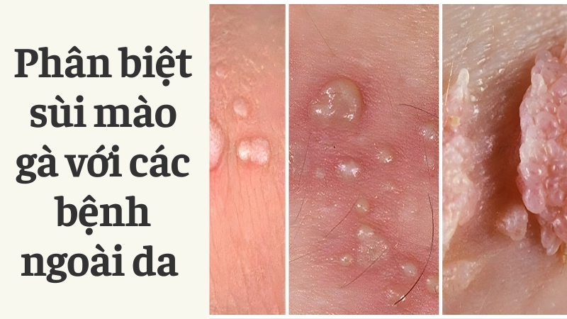 Phân biệt sùi mào gà với các bệnh ngoài da thường gặp