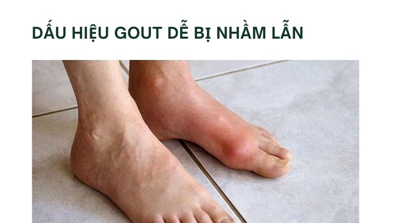 Triệu chứng gout dễ nhầm với bệnh khác