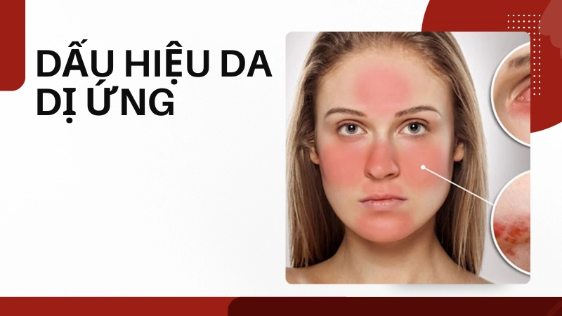 Những cách nhận biết da bị dị ứng để xử lý kịp thời