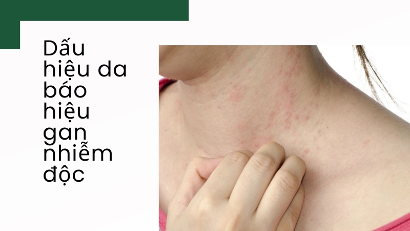 Triệu chứng ngoài da cảnh báo gan tích tụ độc tố