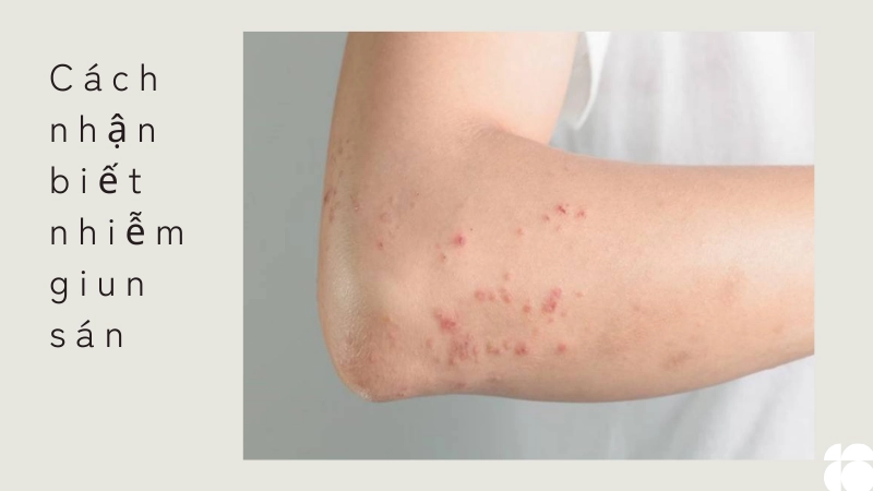 Phương pháp cách nhận biết nhiễm giun sán chuẩn