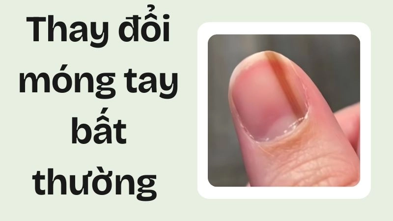 Thay đổi móng tay bất thường chỉ điểm tiểu đường